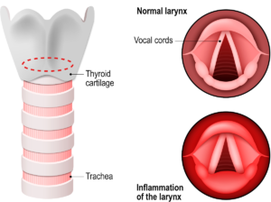 Laryngitis is an inflammation of the larynx mucosa