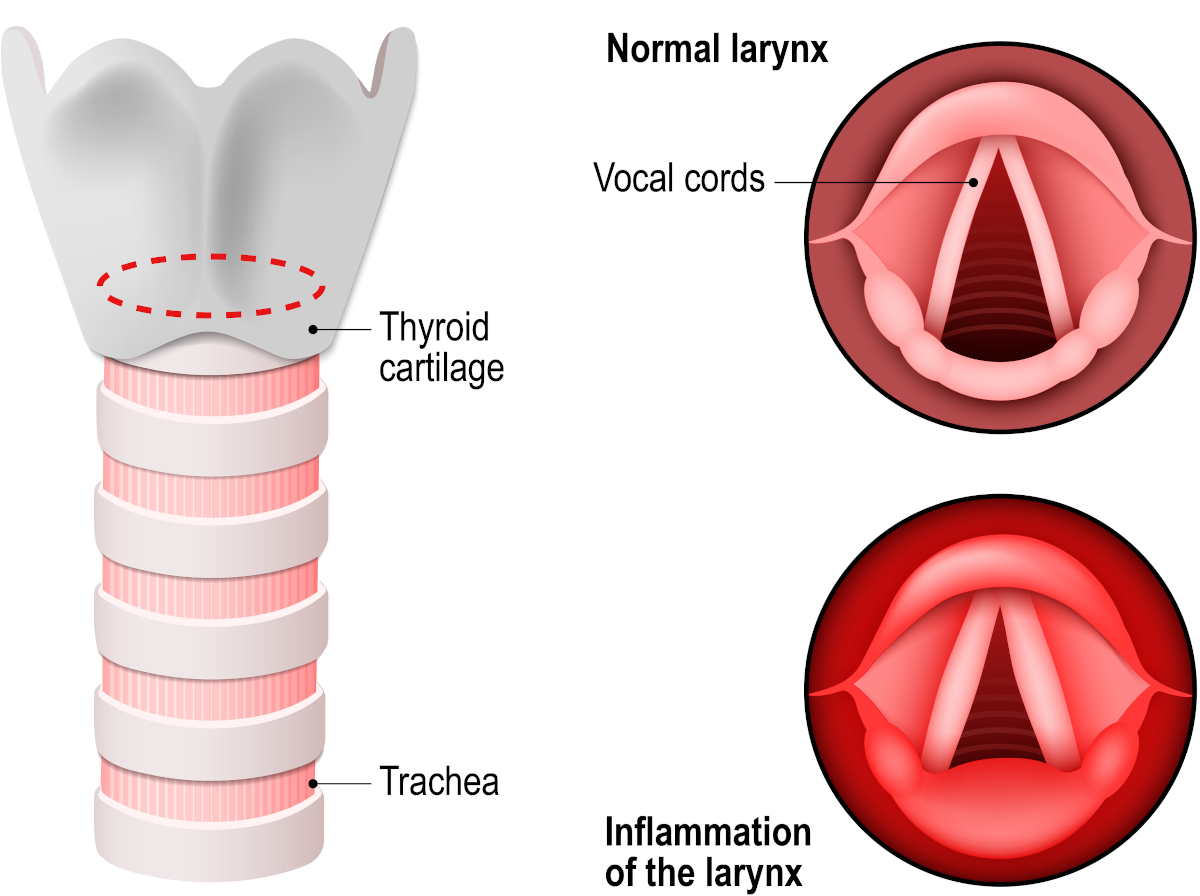 Laryngitis is an inflammation of the larynx mucosa