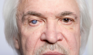 Glaucoma is a chronic eye disease causing high intraocular pressure