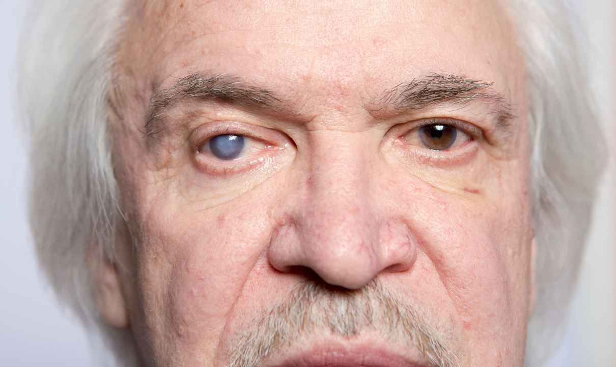 Glaucoma is a chronic eye disease causing high intraocular pressure