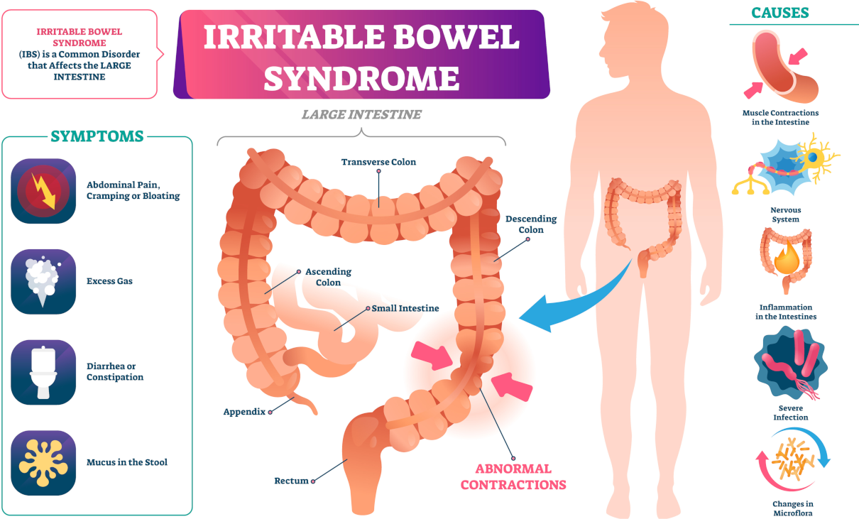 Symptoms of IBS