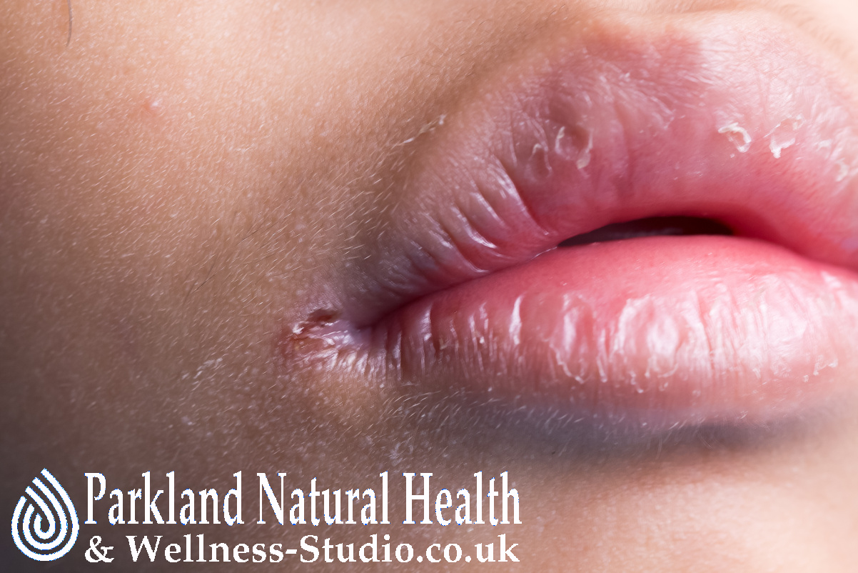 Angular cheilitis - inflammatory process. Inflammation of corner mouth. Lack of vitamins