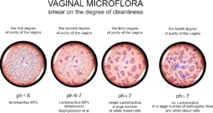 Easy ways to overcome vaginal dysbiosis