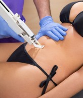 Mesotherapy for stretch marks