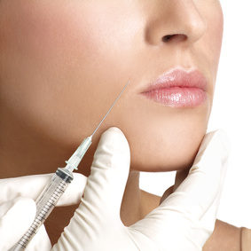Dermal fillers for Smile or Marionette lines