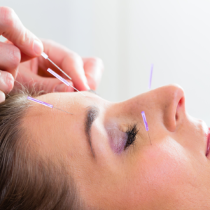 Acupuncture single treatment