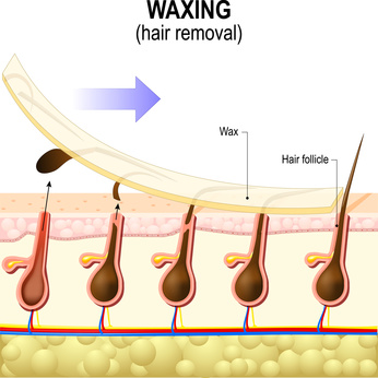 Brazilian Bikini or Hollywood waxing hair removal