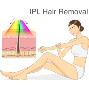 Half arm laser hair removal