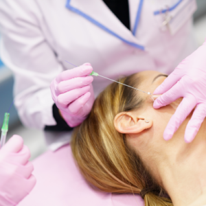 Marionette lines - Polydioxanone Threads Lift