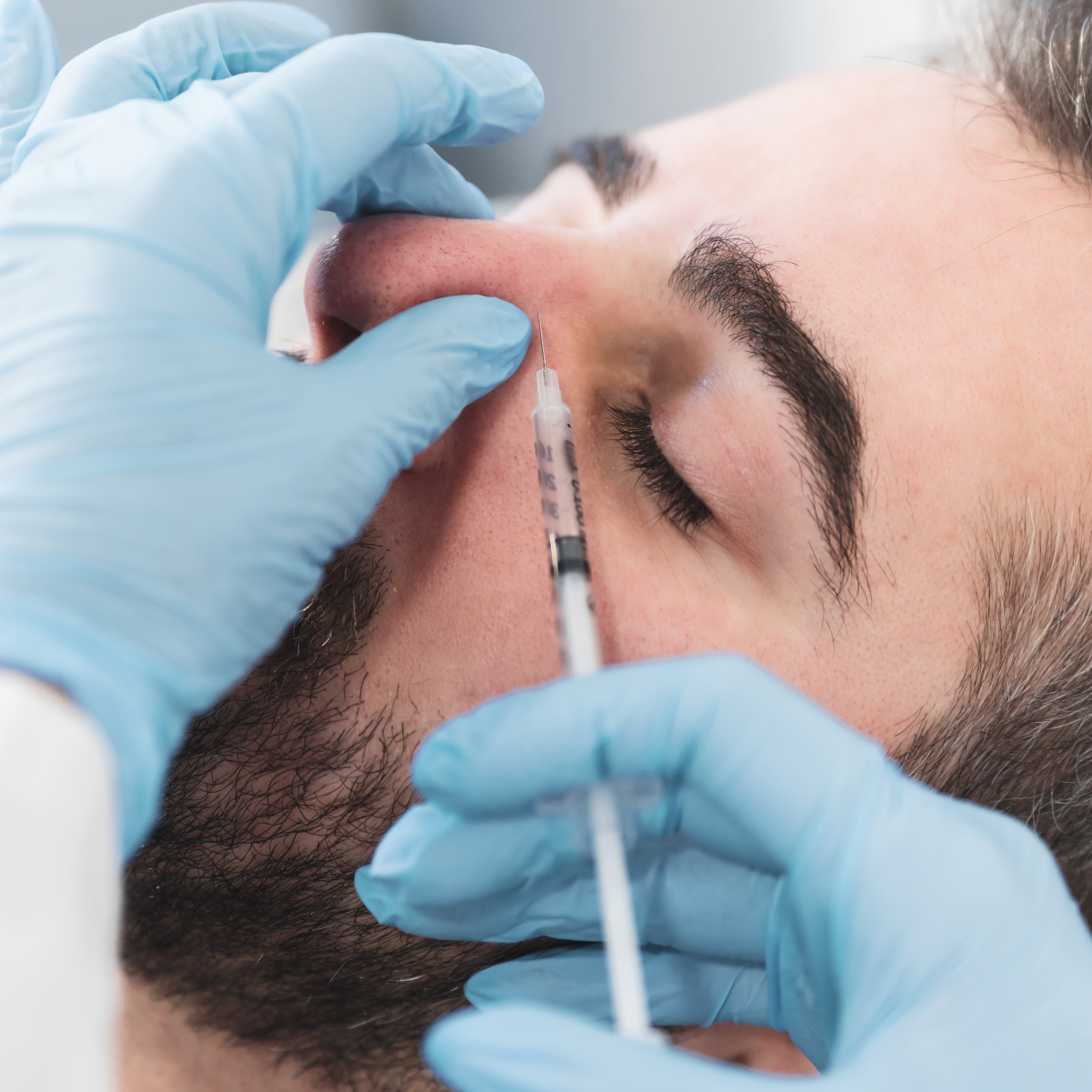 Non-surgical nose correction with HA dermal filler