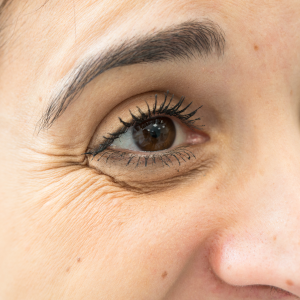 Polydioxanone Threads Crows feet - eye area lines