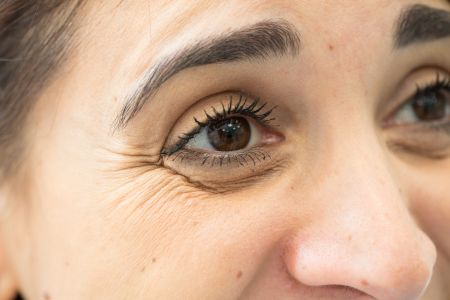 Polydioxanone Threads Crows feet - eye area lines