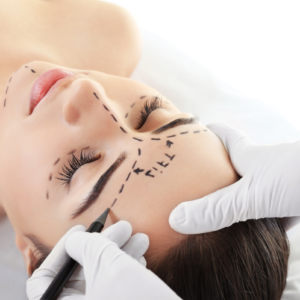 Polydioxanone threads lift for eye bags