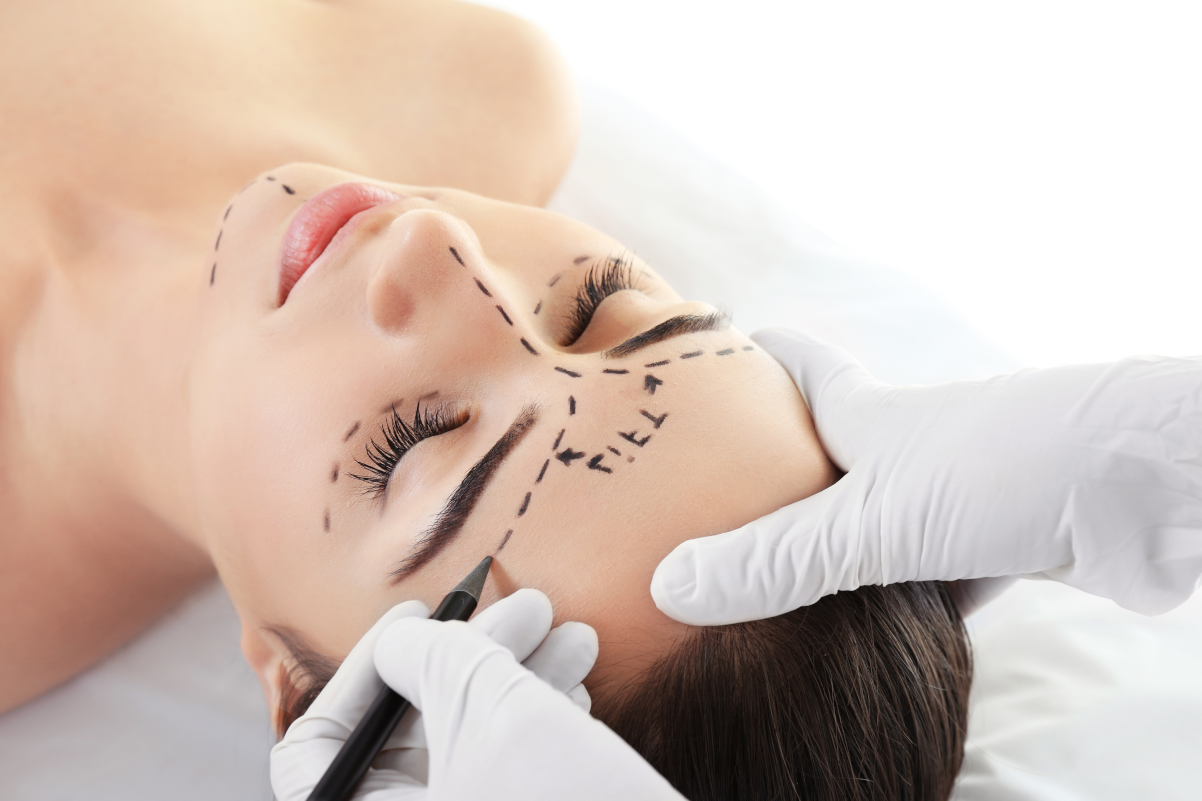 Polydioxanone threads lift for eye bags