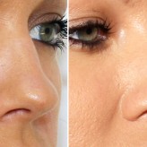 Bunny, smoker's lines treatment with Botulinum Toxin lasts thirty minutes.