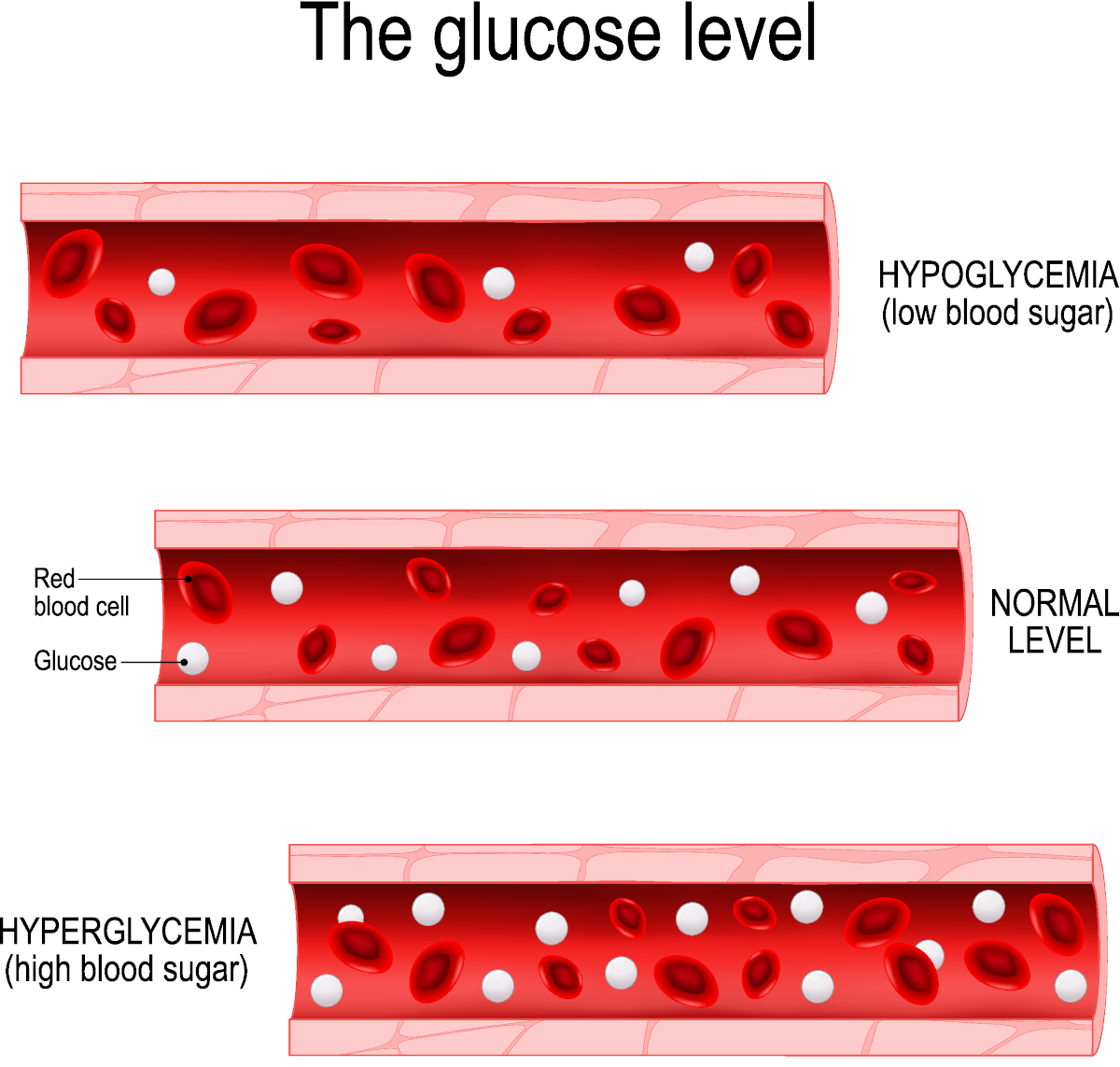 Hypoglycaemia is low blood sugar
