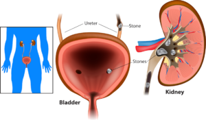 Kidney stone - oxalate