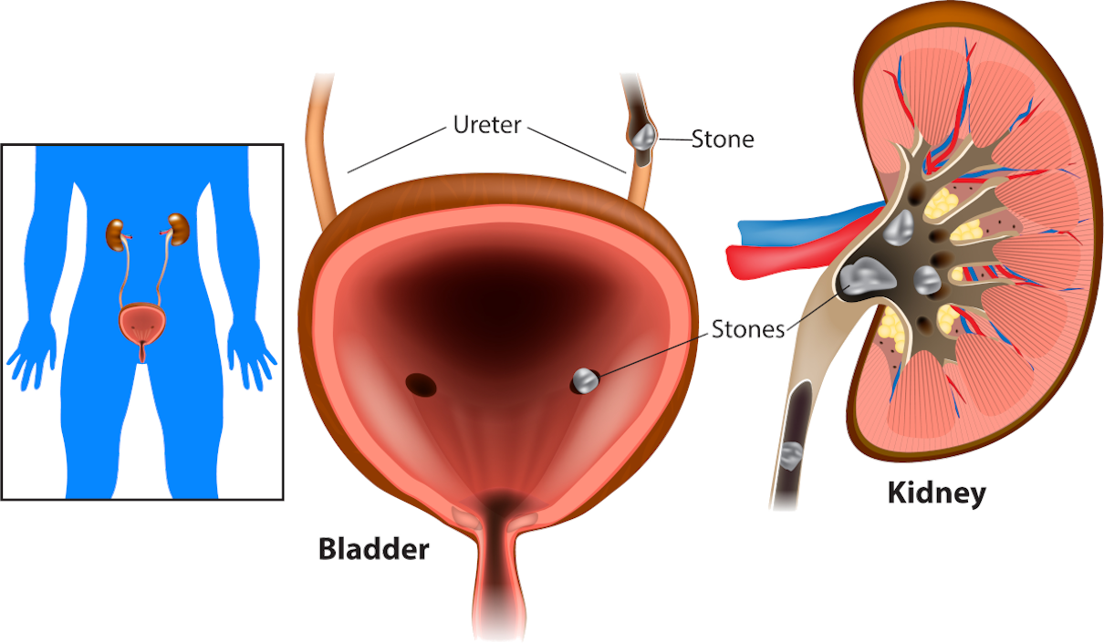 Kidney stone - oxalate