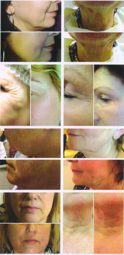 Pictures of faces before and after polydioxanone treatment at Parkland Natural Health