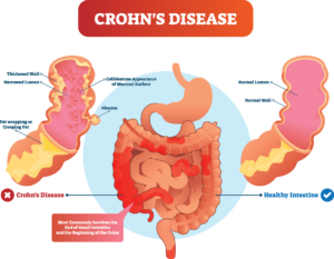 Crohn's disease is an ongoing disorder that causes inflammation of the digestive tract