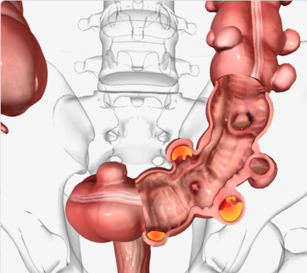 Diverticulitis