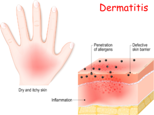 Atopic dermatitis - eczema