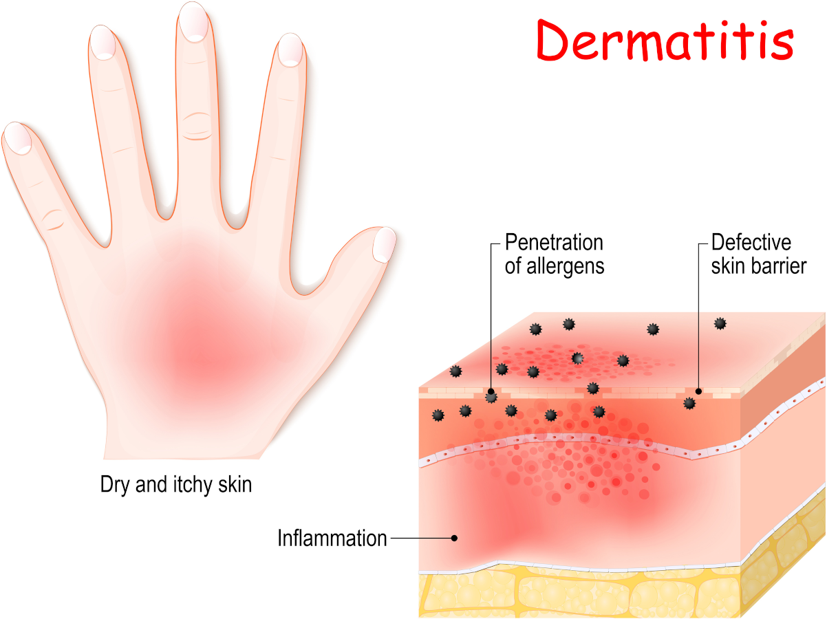 Atopic dermatitis - eczema