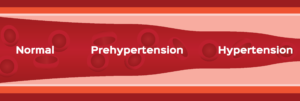 Hypertension factors - high blood pressure
