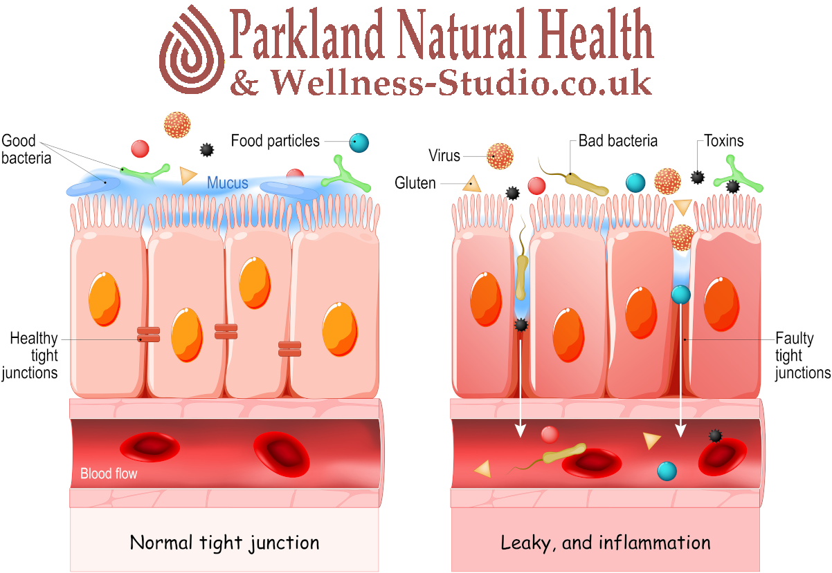 Leaky Gut Syndrome
