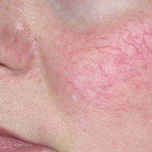 Facial thread veins removal (elecrolysis/diathermy)